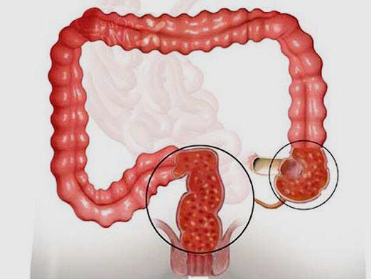 колит у пожилых на фоне запора