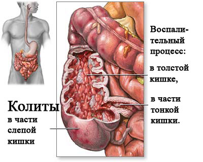 колит