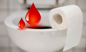 Кровотечение при геморрое