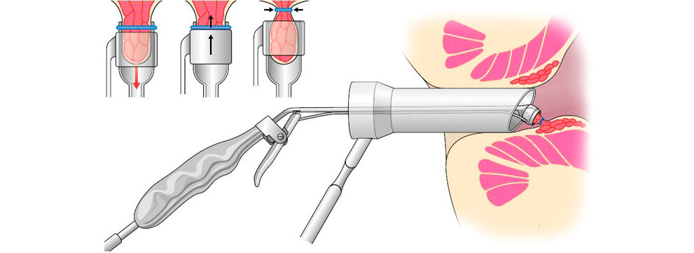 лечение геморроя