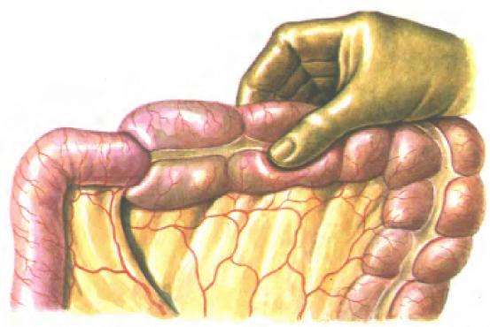 Спастический вид кишечной непроходимости