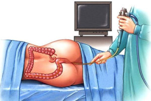 Ректороманоскопия