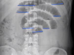 рентген при непроходимости кишечника