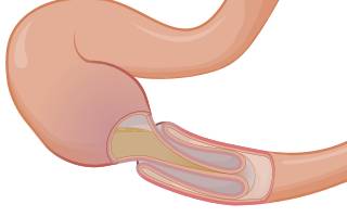 непроходимость кишечника