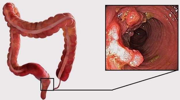 новообразования прямой кишки