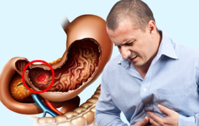 обострение язвы желудка