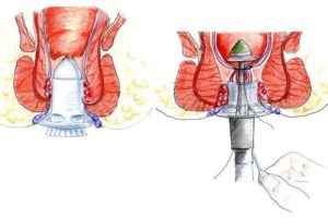 операция на геморрое