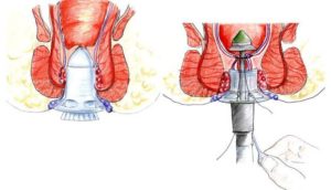 операция Лонго