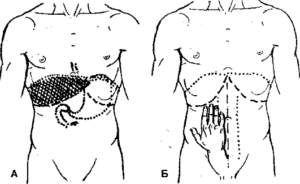 пальпация области 12-перстной кишки