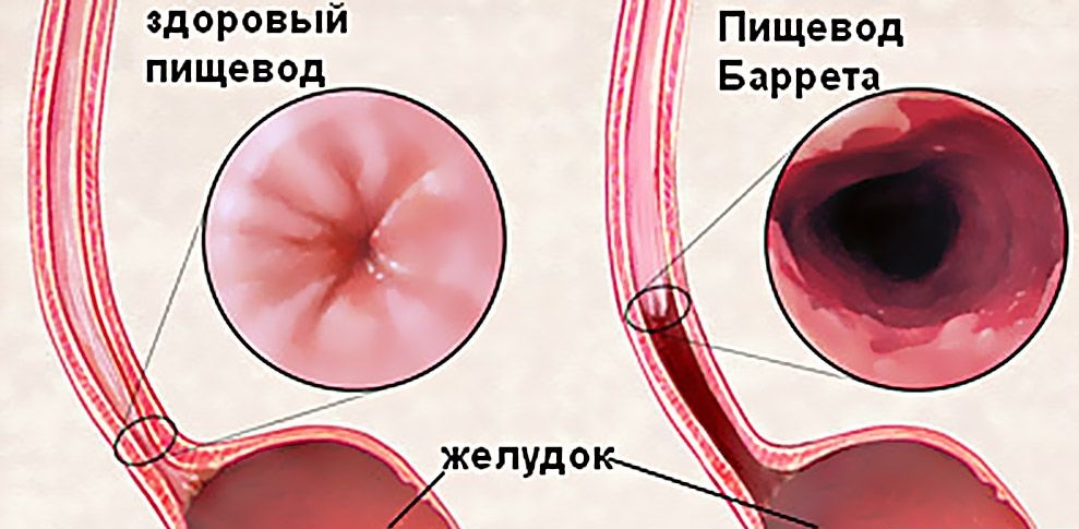 Пищевод Барретта