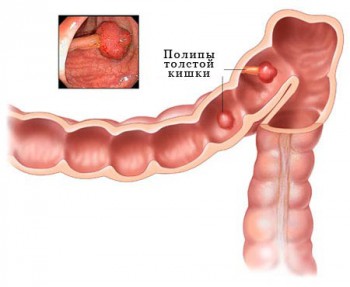 полип в толстом кишечнике