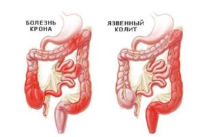 диарея при колите и болезни Крона