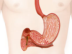 поверхностный гастродуоденит