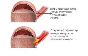 причина изжоги