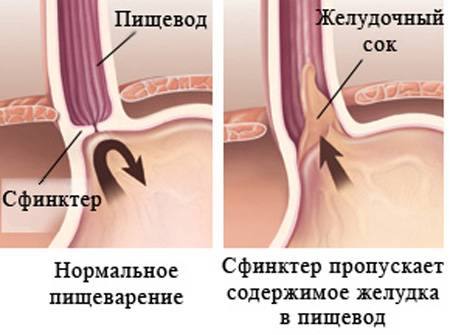 как появляется изжога