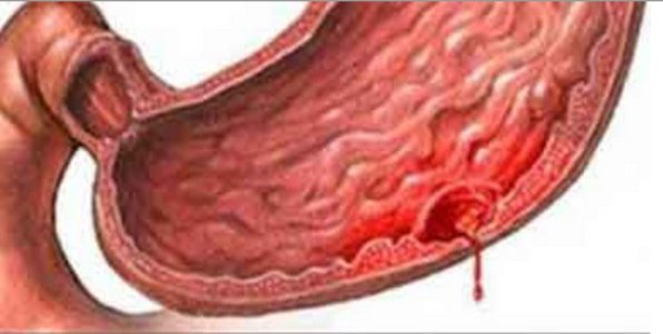 перфорация язвы желудка