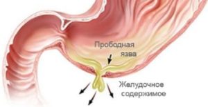 прободение язвы