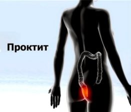 проктит