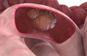 рак 12-перстной кишки