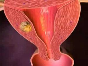 рак матки - причина длительного метеоризма