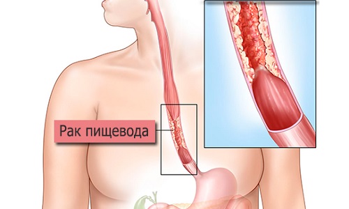 рак пищевода