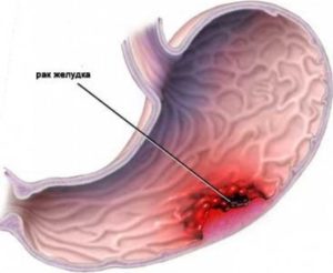 рак желудка