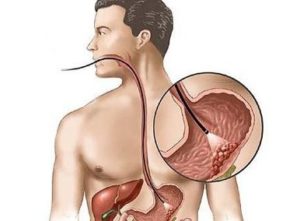 разрастание полипов