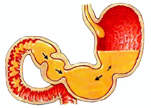 рефлюкс-гастрит билиарный