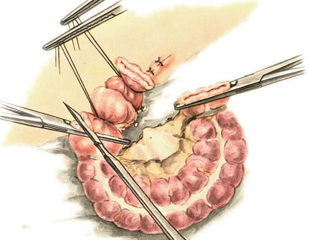 резекция нежизнеспособного участка сигмовидной кишки после расправления узла