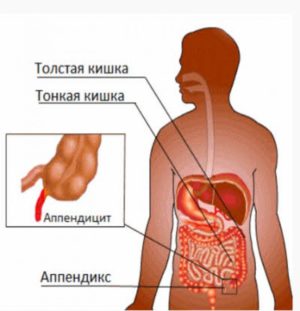аппендицит