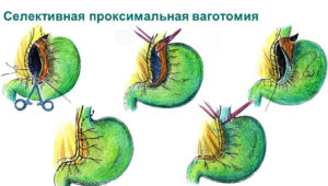 Ваготомия при язвенной болезни