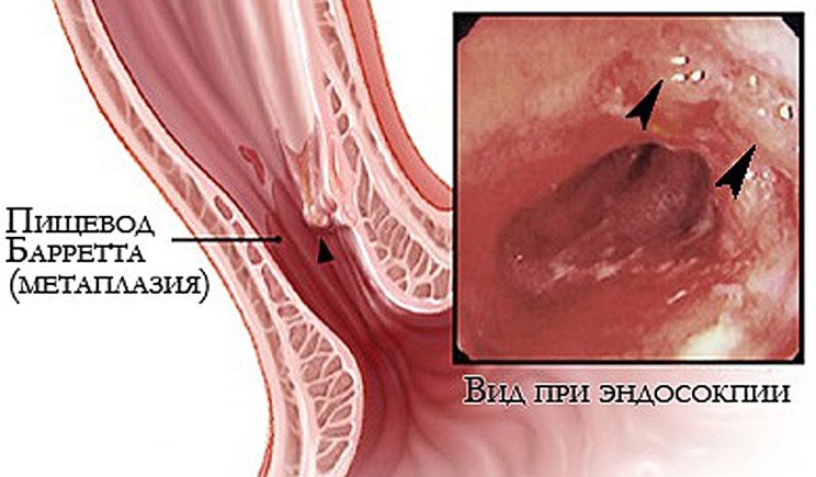 синдром Барретта