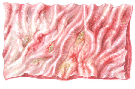 слизистая желудка при коррозивном гастрите