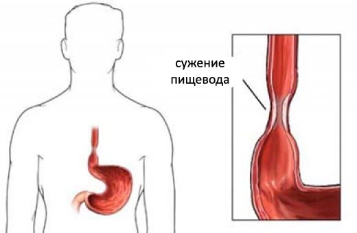 сужение пищевода