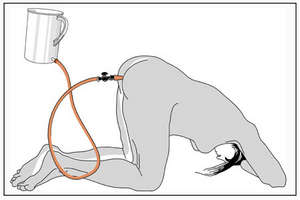 техника постановки клизмы