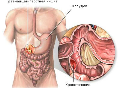 темная кровь при кровотечении из верхних отделов ЖКТ