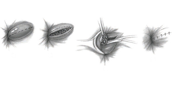 тромбэктомия