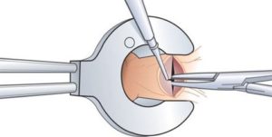 удаление анальной трещины