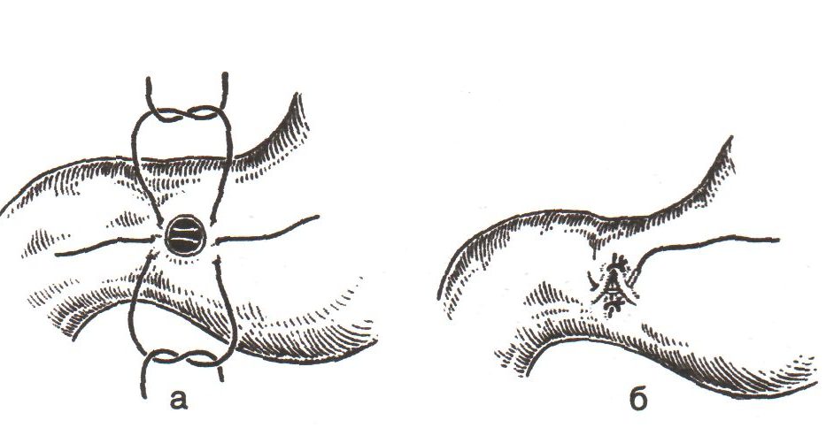 ушивание перфоративной язвы