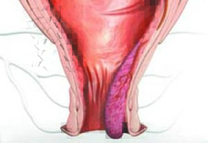 выпадение геморроя на поздних стадиях
