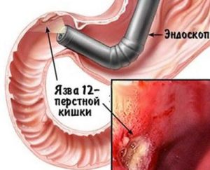 язвенная болезнь 12-перстной кишки