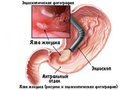 язва антрального отдела желудка