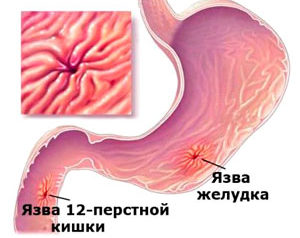 язвенная болезнь желудка и дпк