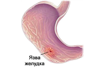 язва желудка