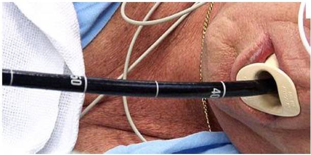 в загубник вводится наконечник гастроскопа