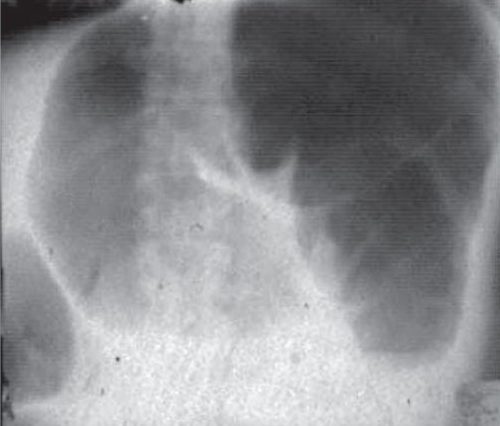 заворот сигмовидной кишки