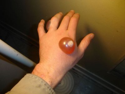 Ожоги которые оставляет жидкий азот