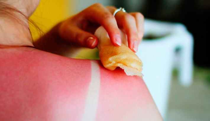 Охлаждение ожога