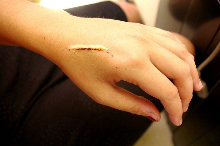 Мазь от шрамов и рубцов после ожогов самое эффективное