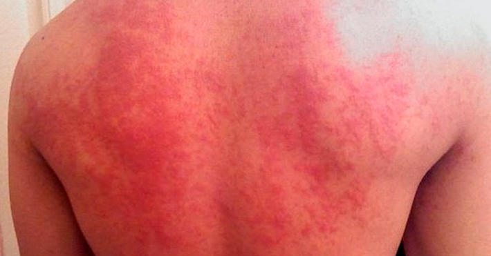 Аллергическая реакция